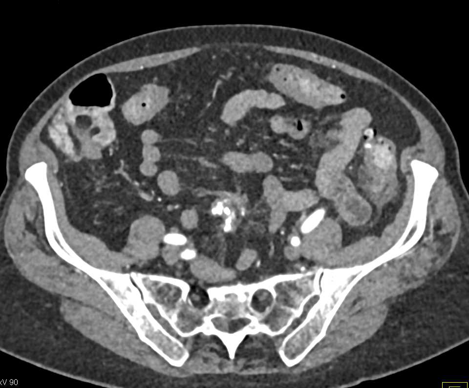 Carcinoid Tumor in Root of Mesentery with Desmoplastic Reaction and LIver Metastases - CTisus CT Scan