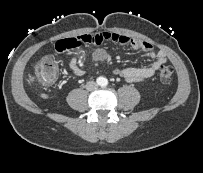 Melanoma with Distal Small Bowel Intussusceptions - CTisus CT Scan