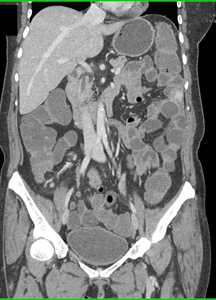 Small Bowel Bleed in the Jejunum - CTisus CT Scan