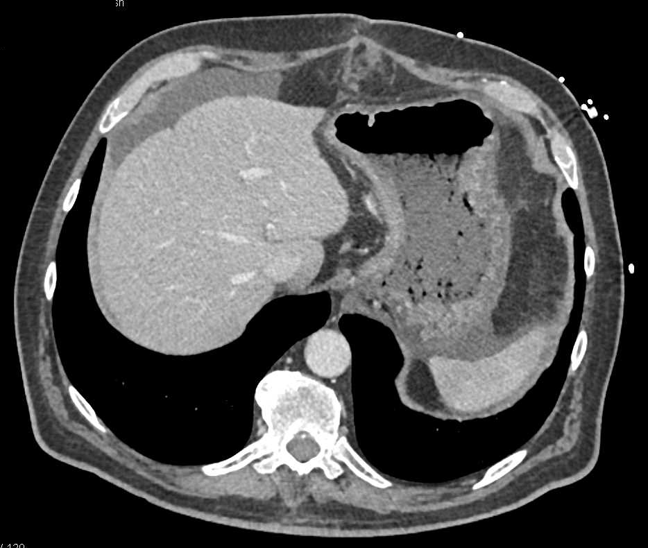 Infiltrating Gastric Adenocarcinoma with Ascites - CTisus CT Scan