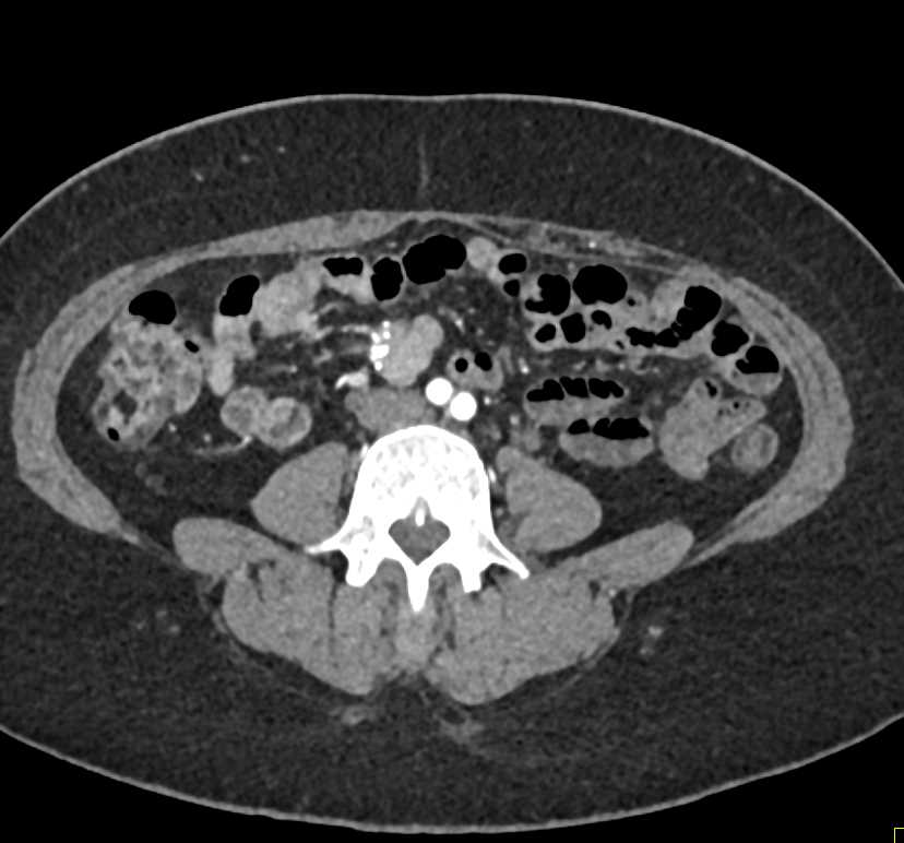 Carcinoid Tumor in the Root of the Mesentery - CTisus CT Scan