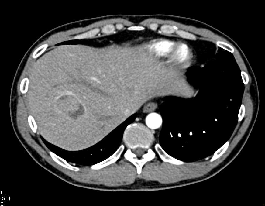 Carcinoid Tumor Root of Mesentery and Liver Metastases - CTisus CT Scan