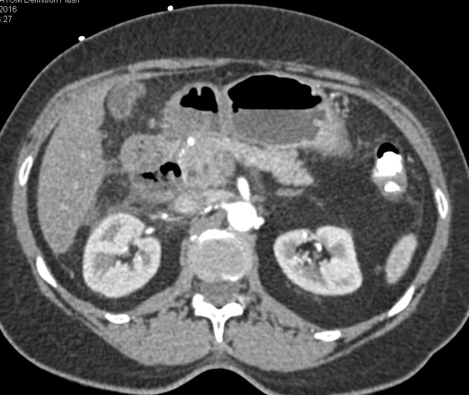 Perforated Duodenum Post Endoscopic Retrograde Cholangiopancreatography (ERCP) - CTisus CT Scan