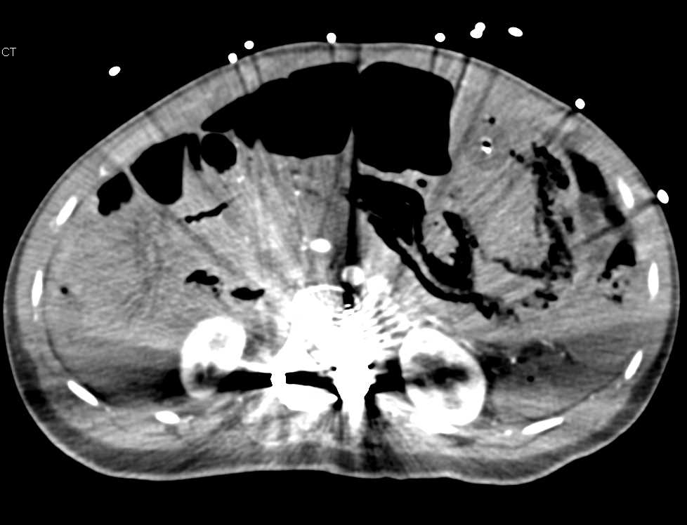 Infarcted Bowel with Portal Venous Gas and Pneumoperitoneum - CTisus CT Scan