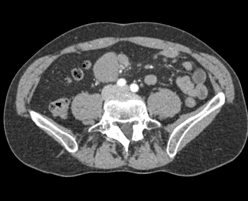 Carcinoid Tumor Root of Mesentery - CTisus CT Scan