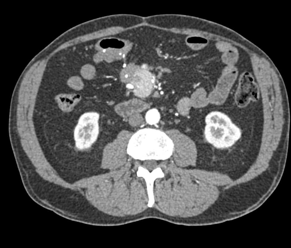 Carcinoid Tumor Root of Mesentery with Desmoplastic Reaction and Liver Metastases - CTisus CT Scan