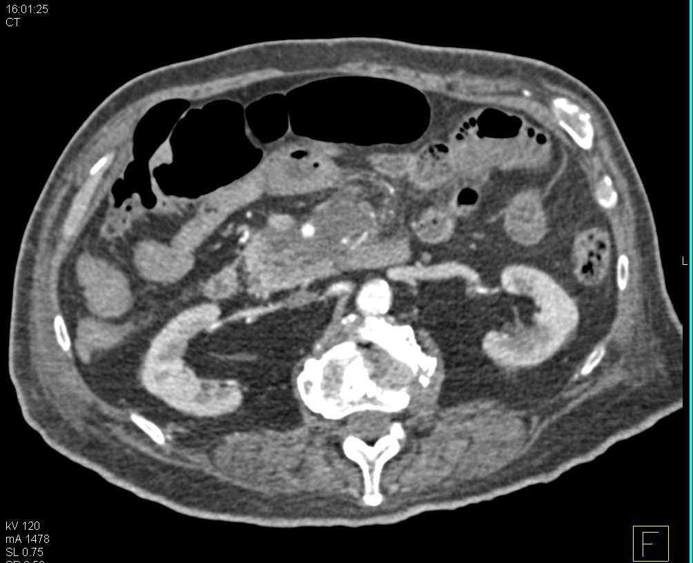 Small Bowel Adenocarcinoma with Vascular Encasement - CTisus CT Scan