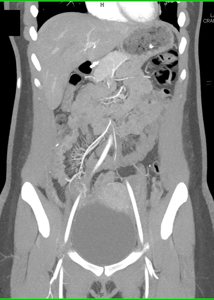 Crohn's Disease with Comb Sign Terminal Ileum - CTisus CT Scan