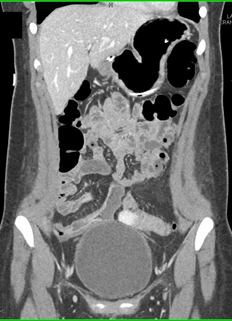 Crohns Disease With Comb Sign Terminal Ileum Small Bowel Case