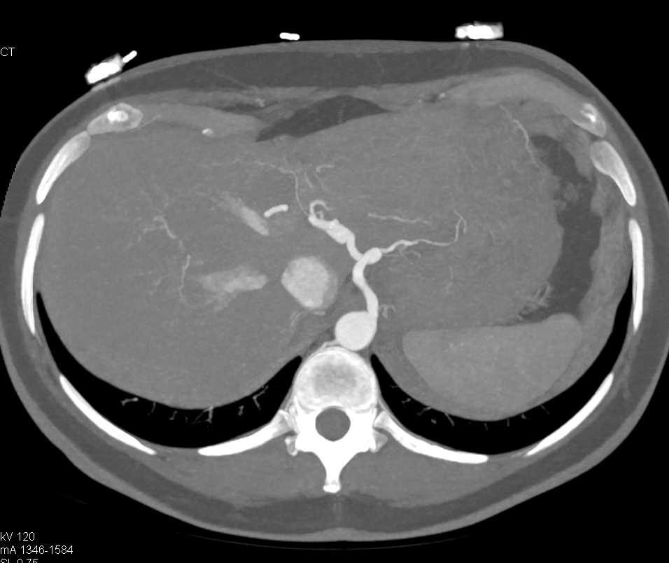 Focal Dissection Superior Mesenteric Artery (SMA) and Small Bowel Enteritis - CTisus CT Scan