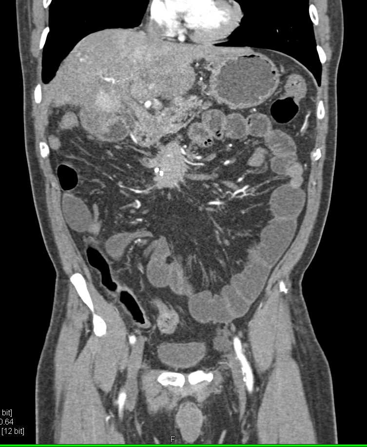 Carcinoid Tumor with Desmoplastic Reaction and Liver Metastases - CTisus CT Scan