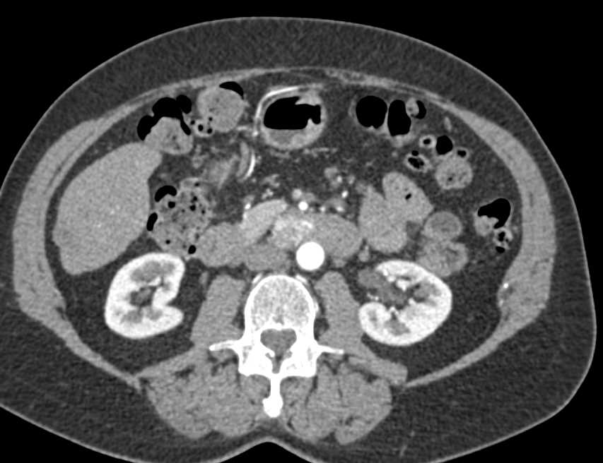 GIST Tumor in Duodenum Simulates a Pancreatic Pancreatic Neuroendocrine Tumor (PNET) - CTisus CT Scan