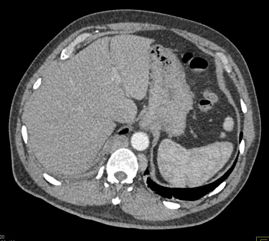 Carcinoid Tumor in 4th Portion Duodenum - CTisus CT Scan