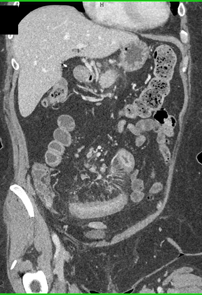 Crohn's Enteritis Involves Distal Small Bowel - CTisus CT Scan