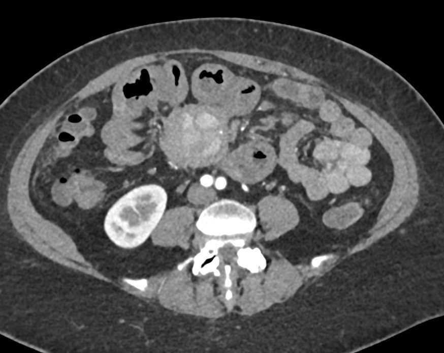 Carcinoid Tumor in Root of Mesentery and Vascular Invasion - CTisus CT Scan