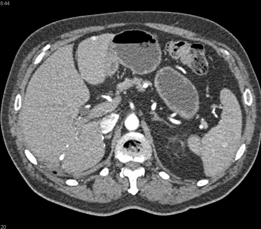 Metastatic Renal Cell Carcinoma to the Small Bowel Especially the Duodenum - CTisus CT Scan