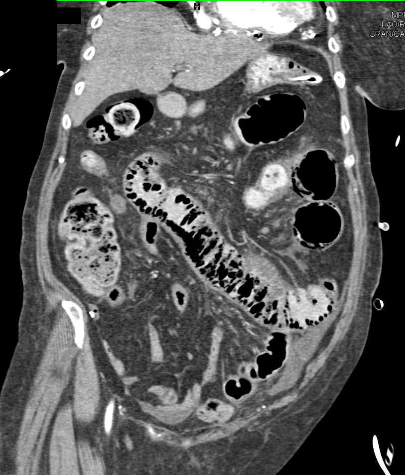 Pneumatosis with Ischemic Small Bowel - CTisus CT Scan