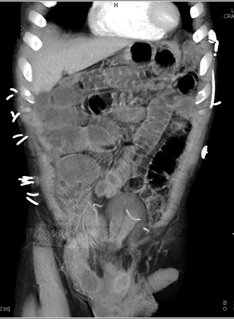 Small Bowel Obstruction (SBO) due to an incarnated loop of bowel in a right inguinal hernia - CTisus CT Scan