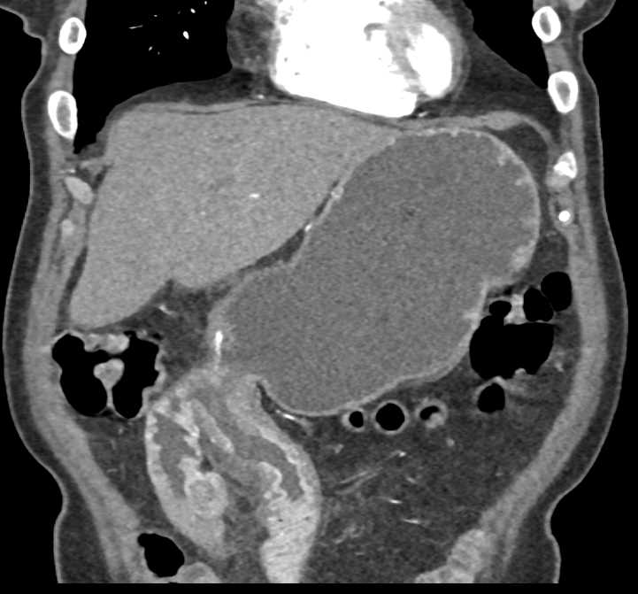 Gastrojejunostomy with Recurrence at Anastomosis - CTisus CT Scan