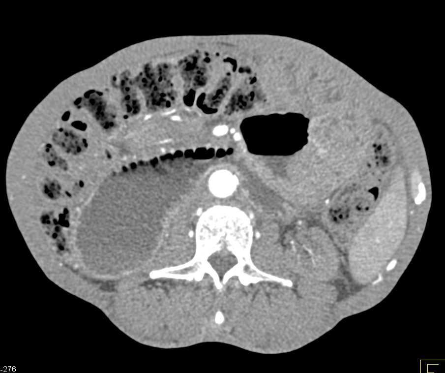 Small Bowel Obstruction (SBO) with Adhesions - CTisus CT Scan