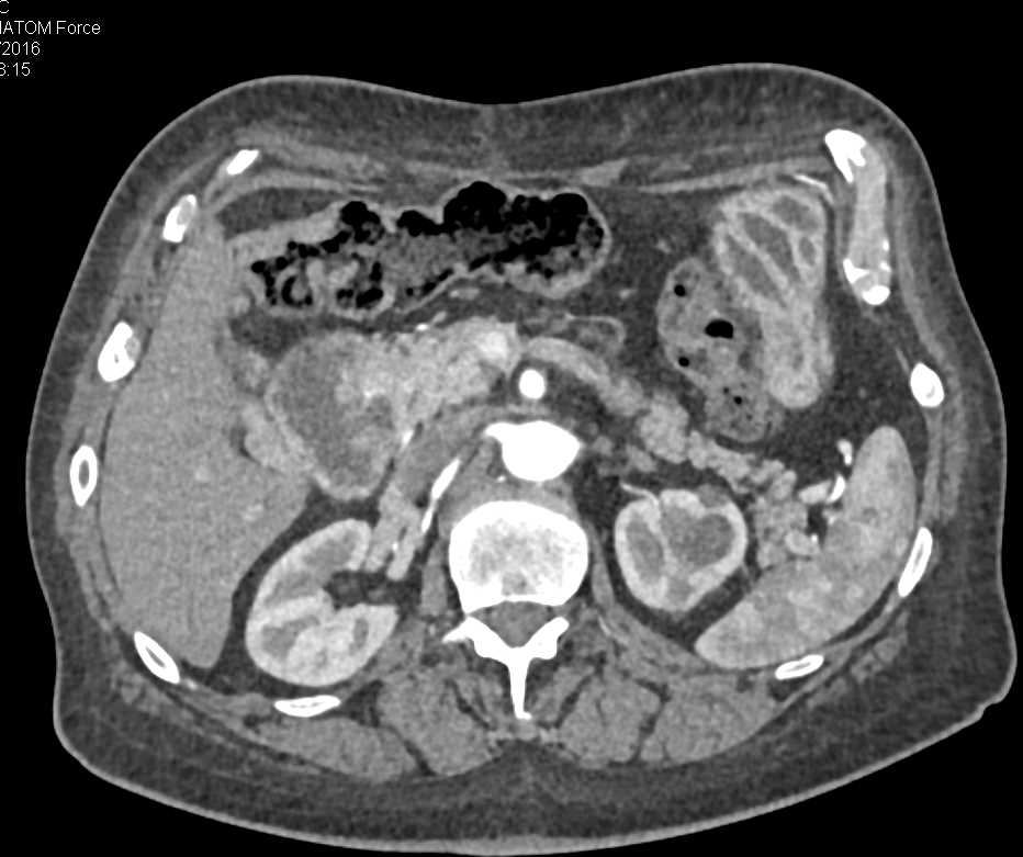 Adenocarcinoma of the Duodenum - CTisus CT Scan