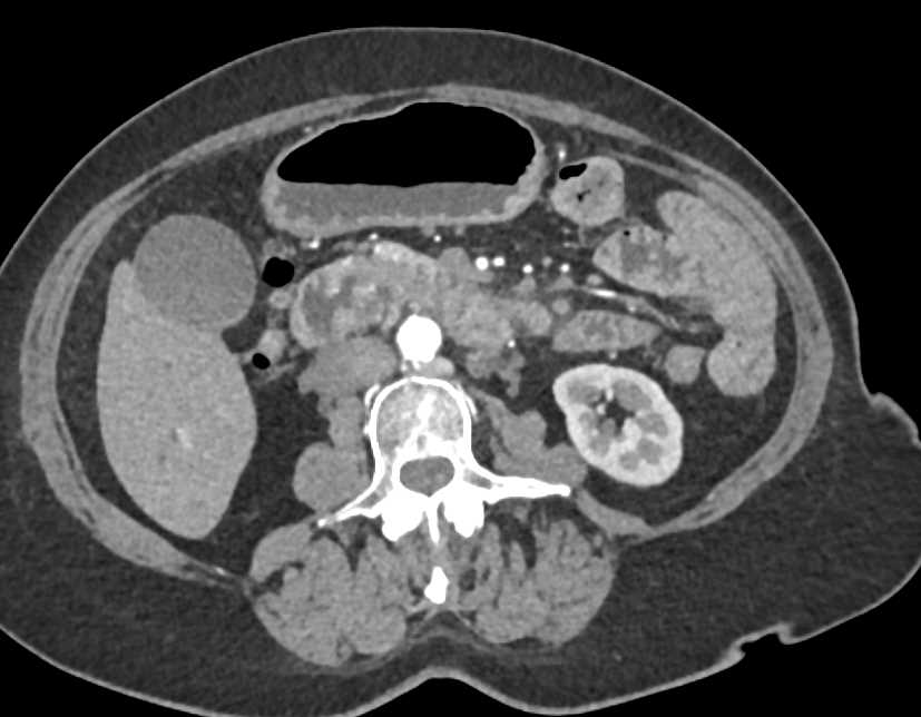 Duodenal Adenocarcinoma - CTisus CT Scan