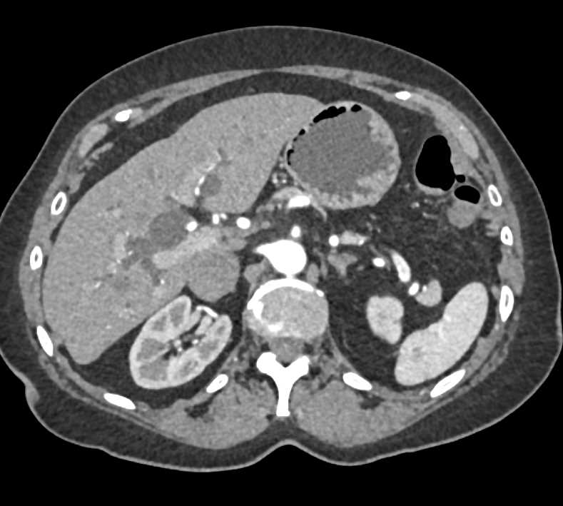 Duodenal Adenocarcinoma - CTisus CT Scan