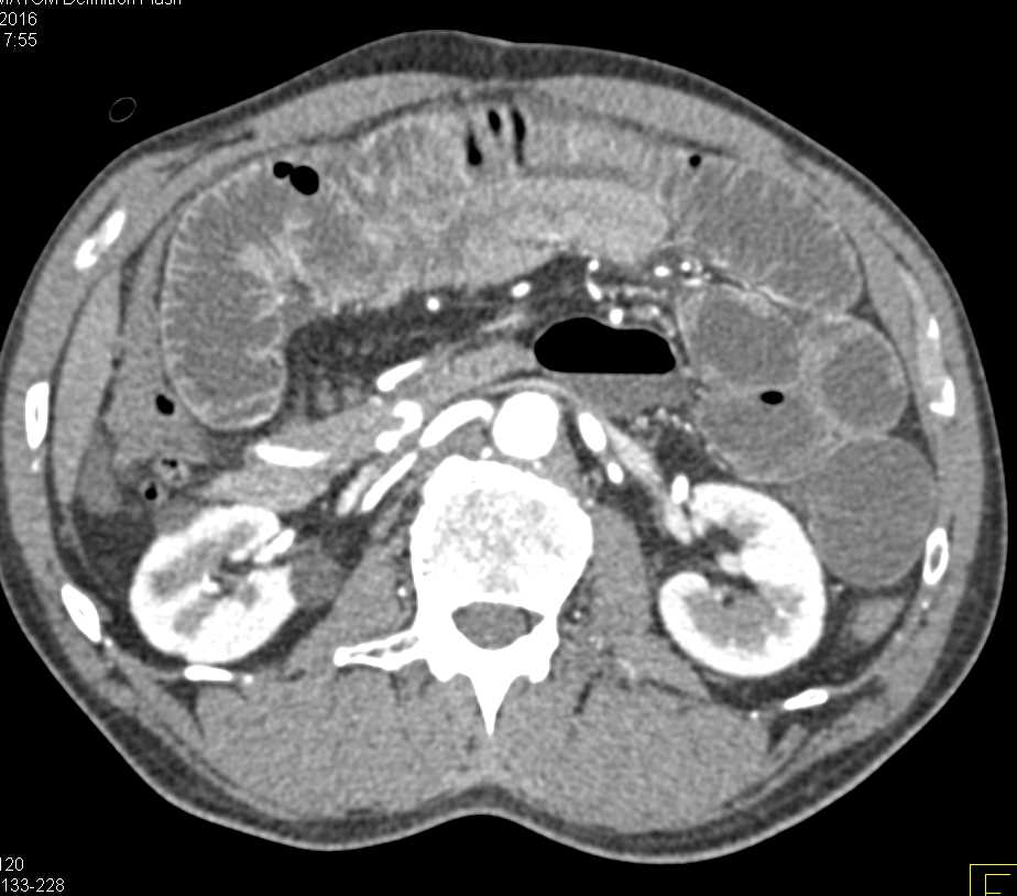 Small Bowel Obstruction (SBO) due to Midgut Volvulus - CTisus CT Scan