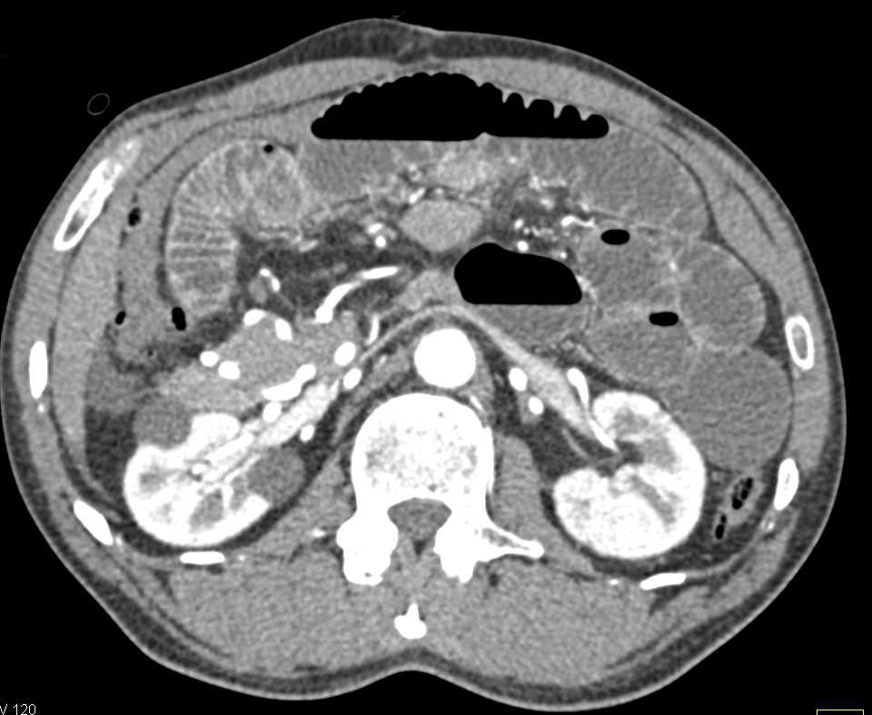 Small Bowel Obstruction (SBO) with Midgut Volvulus - CTisus CT Scan