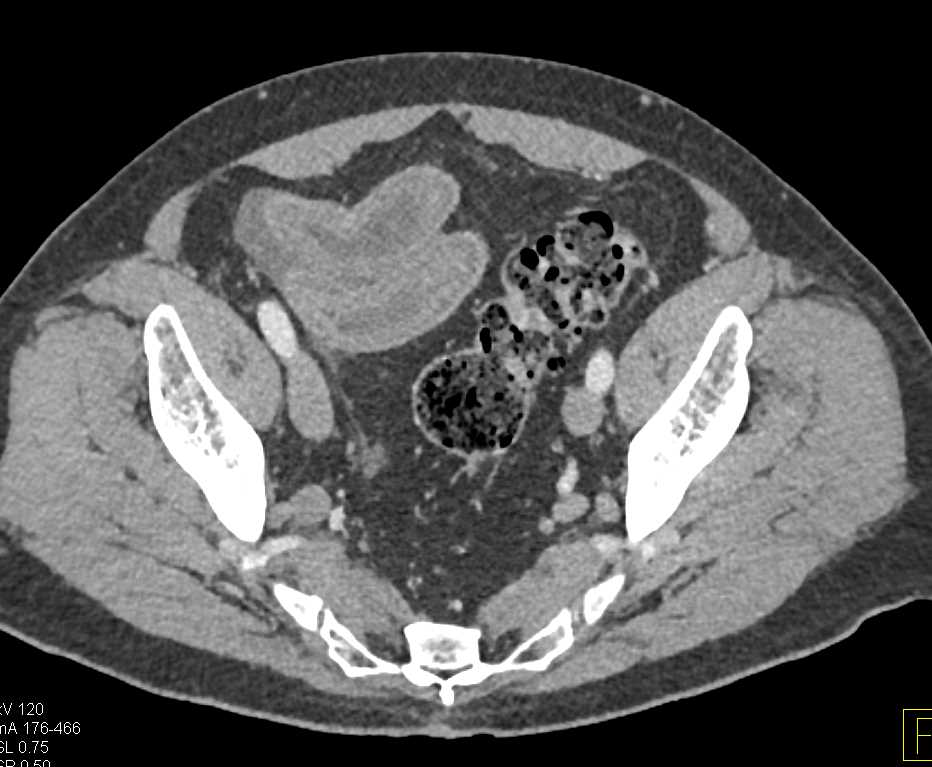 Infectious Enteritis Distal Small bowel - CTisus CT Scan