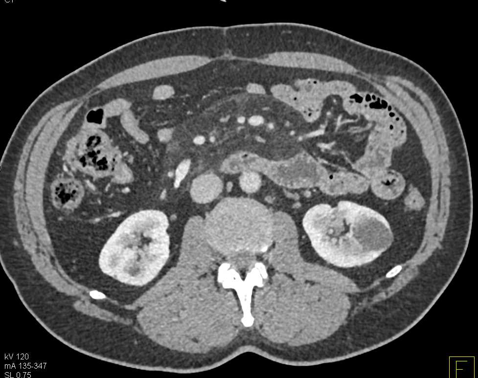 Mesenteric Panniculitis - CTisus CT Scan