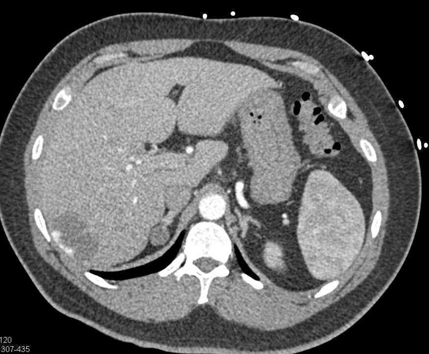 Vascular GIST Tumor Jejunum - CTisus CT Scan