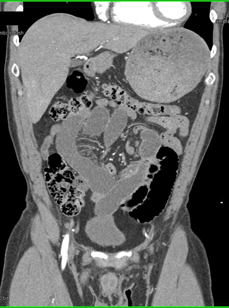 Small Bowel Obstruction Sbo Due To Adhesions Small Bowel Case