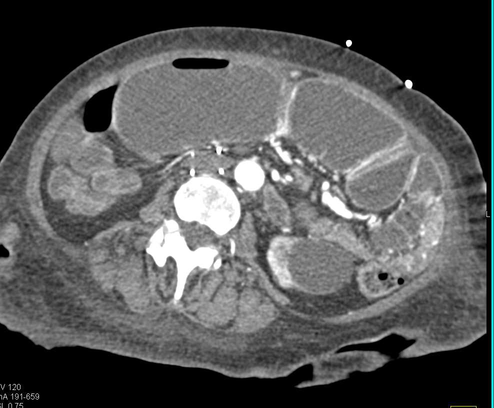 Small Bowel Obstruction (SBO) due to Midgut Volvulus - CTisus CT Scan