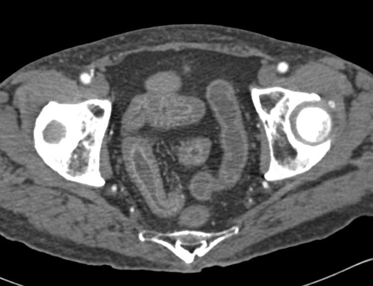 Active Crohn's Disease with Comb Sign - CTisus CT Scan