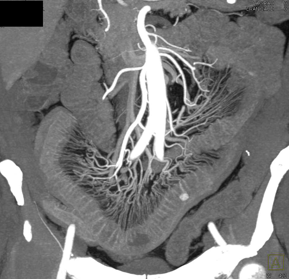 Active Crohn's Disease with Comb Sign - CTisus CT Scan