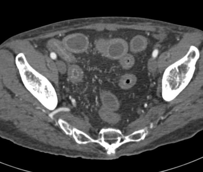 Active Crohn's Disease with Comb Sign - CTisus CT Scan