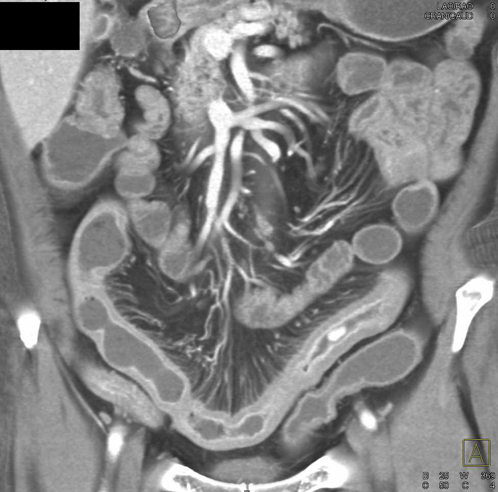 Active Crohn's Disease with Comb Sign - Small Bowel Case Studies ...