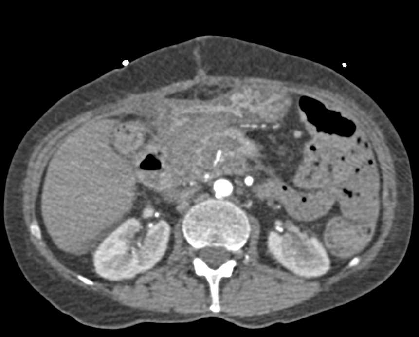 Active Bleed in the Duodenum - CTisus CT Scan