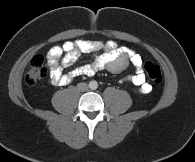 Small Bowel GIST Tumor Missed on Axial Report - CTisus CT Scan