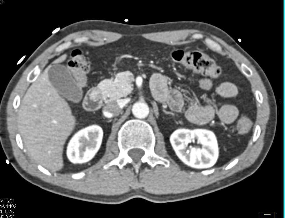 1cm Carcinoid in the Duodenum - CTisus CT Scan