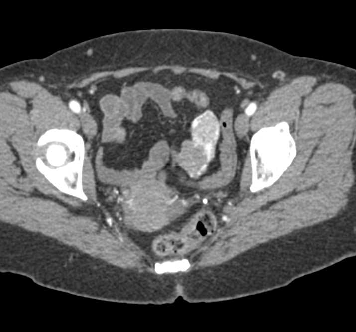 Vascular Small Bowel GIST Tumor - CTisus CT Scan