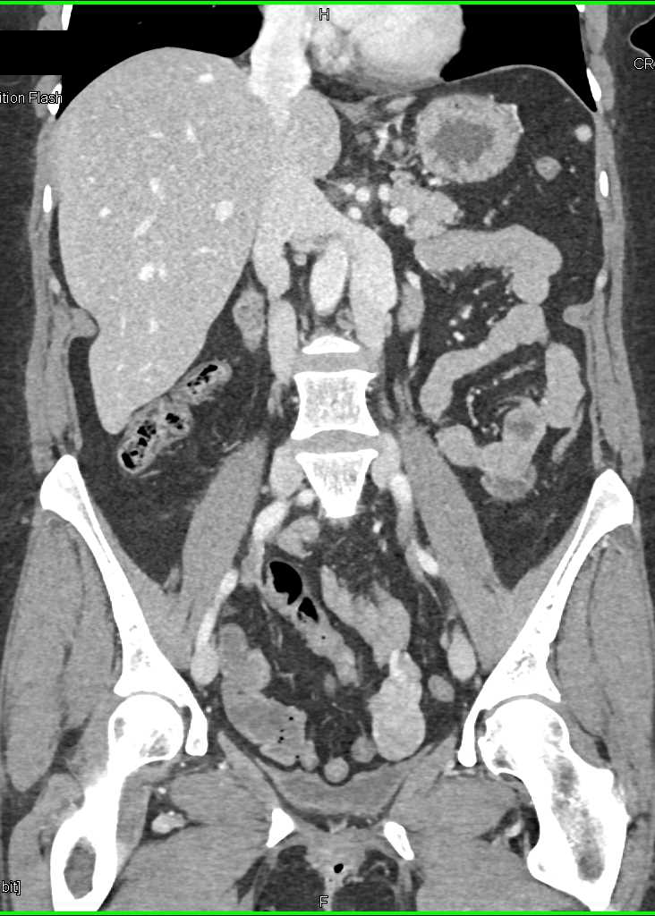 Vascular Small Bowel GIST Tumor - CTisus CT Scan