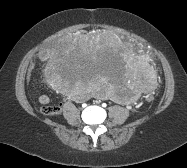 Small Bowel GIST Tumor Arises from Duodenum and Extends Into the Pelvis - CTisus CT Scan