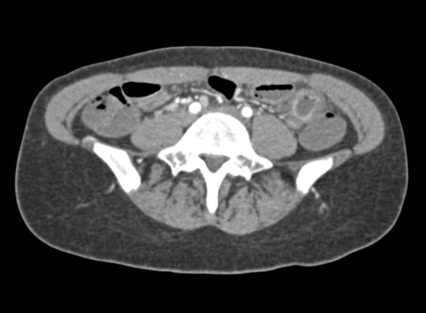 Crohn's Disease - CTisus CT Scan