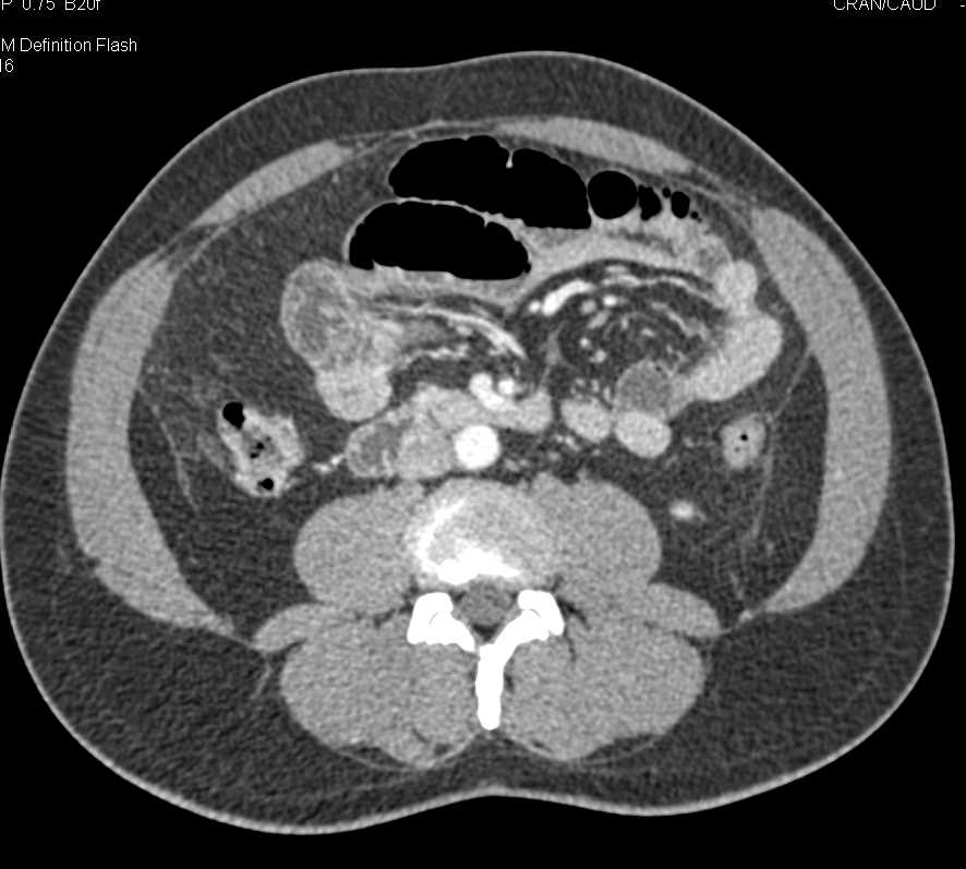 Scrotal Edema with Small Bowel Hernia and Ischemic Bowel - Small Bowel ...