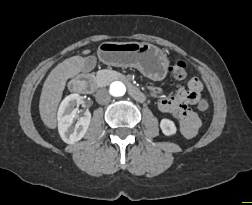 Duodenal Adenocarcinoma - CTisus CT Scan