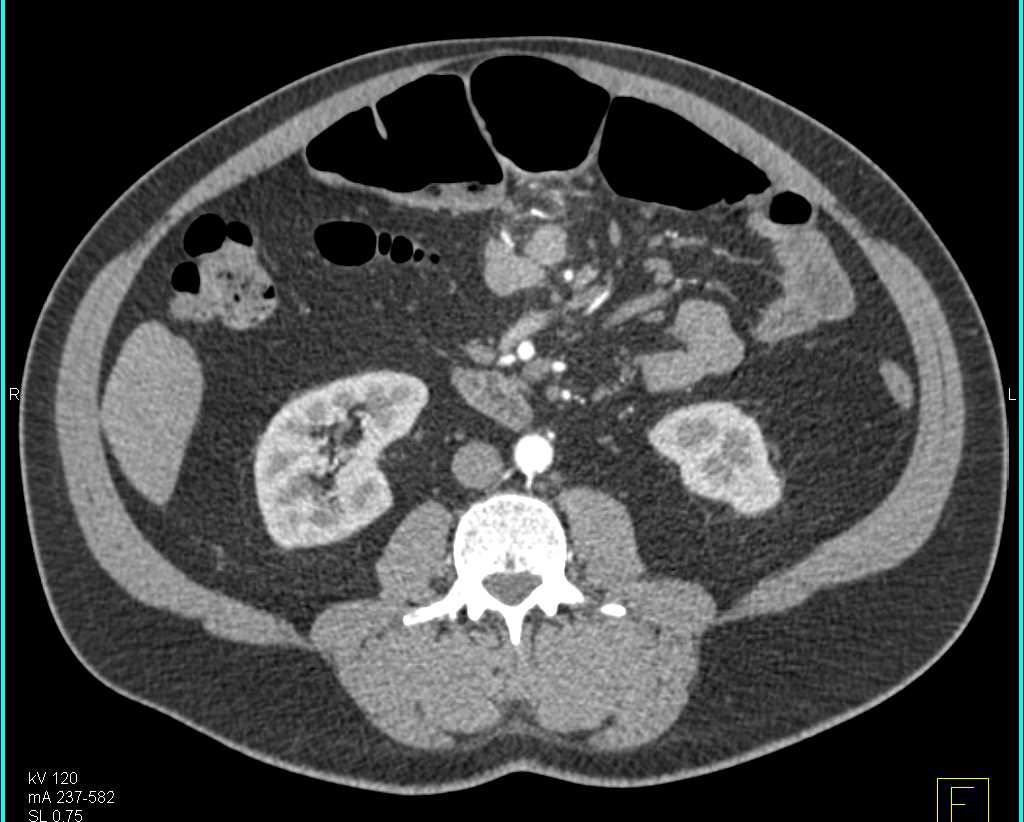 Partial Small Bowel Obstruction (SBO) with Ischemic Bowel - CTisus CT Scan