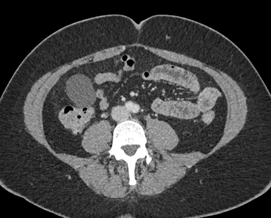 Mesenteric Cyst - CTisus CT Scan