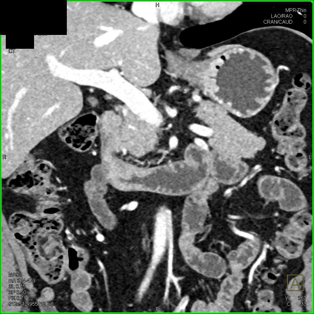 Duodenal Adenocarcinoma - CTisus CT Scan